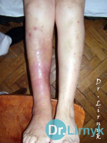Erysipelas: after treatment. Treatment for 7 days.